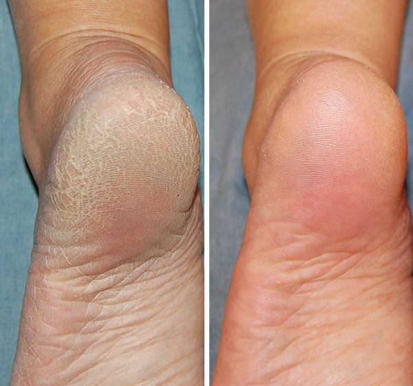 Foot File